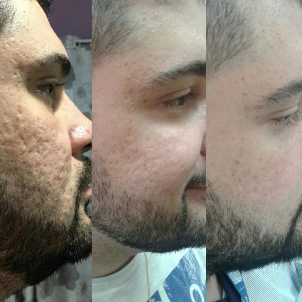 Ácido Hialurónico 24H Hombre