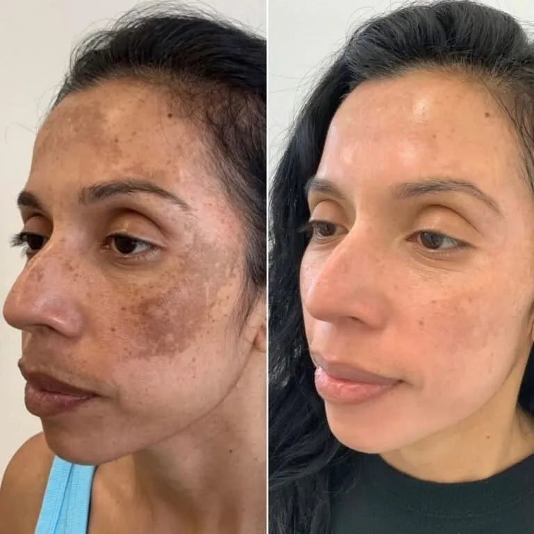 serum-jabon kojic