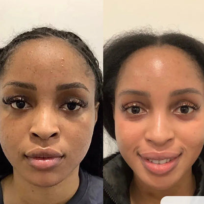 Reset kit DermaSkin |Peeling+Niacinamida