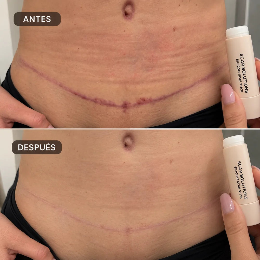 Comparación antes y después de cicatriz abdominal