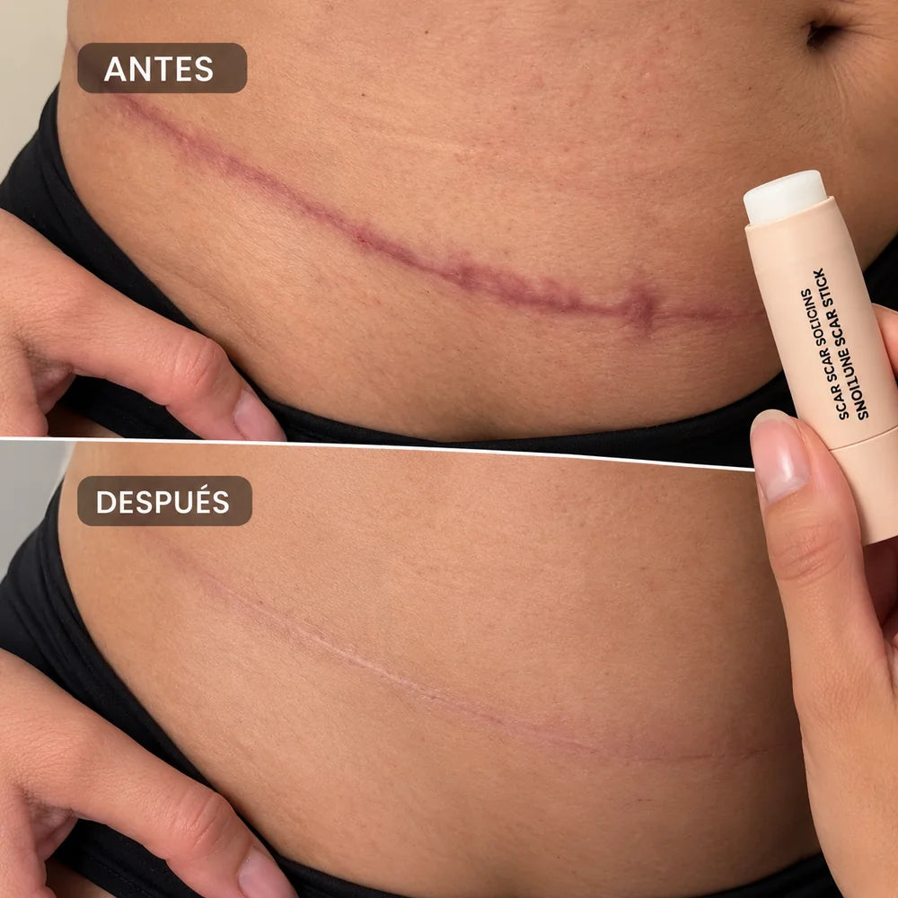 Resultado visual de cicatriz abdominal
